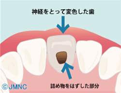 ウォーキングブリーチ