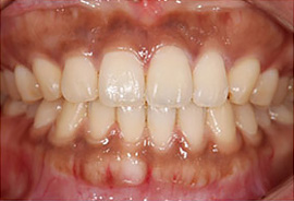 歯茎（歯肉）の黒ずみ改善法