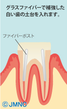 セラミッククラウン法-2