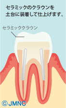 セラミッククラウン法-3