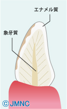 ラミネートべニア法