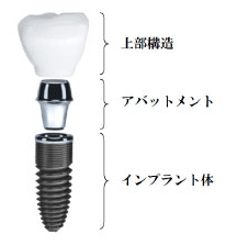 インプラント構造