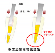 垂直加圧充填